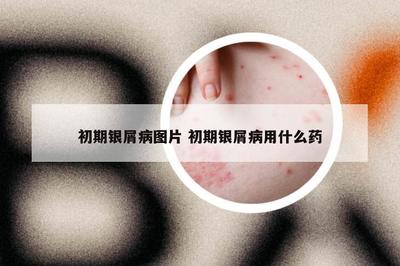 初期银屑病图片 初期银屑病用什么药