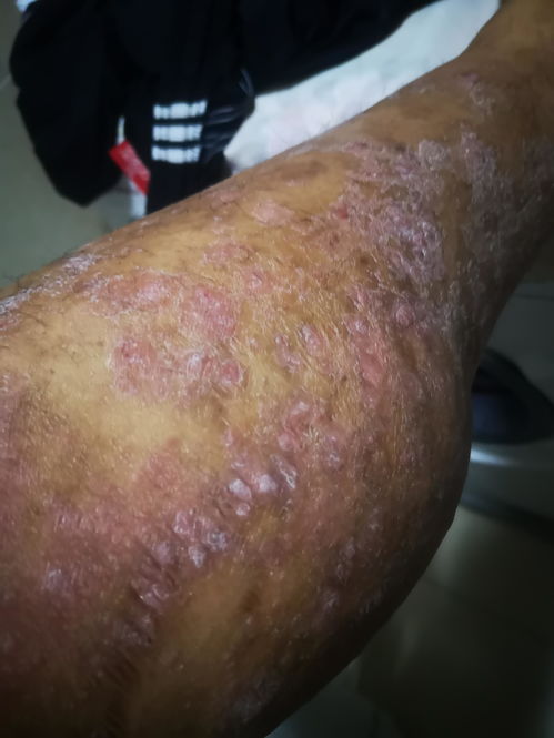 20年老牛皮癣接受可善挺治疗记录