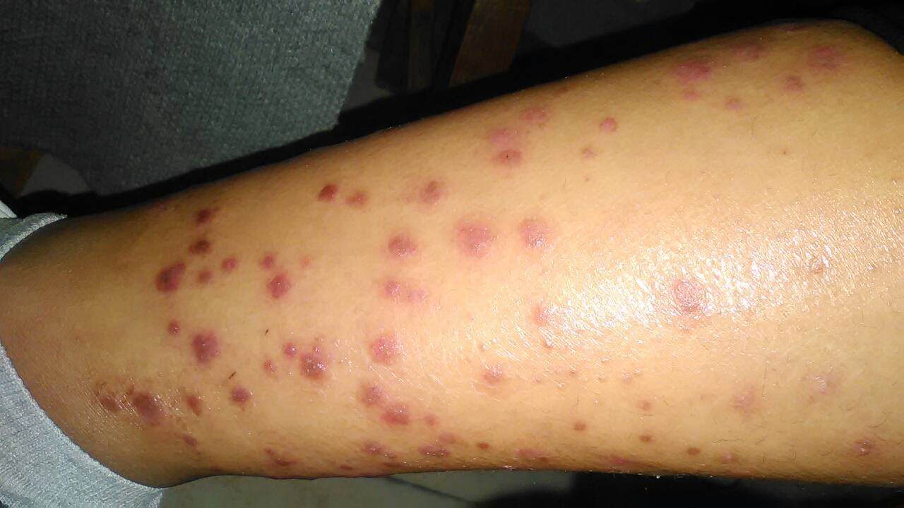 银屑病（牛皮癣）的综合治疗与穴位按摩辅助疗法