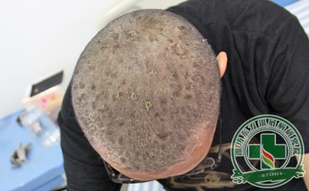 银屑病甲的悲催过程