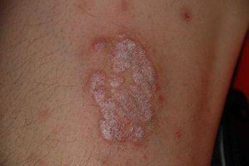 老偏方治疗牛皮癣（银屑病） 传统智慧的探索与考量