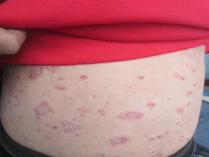 牛皮癣做好日常护理的重要性