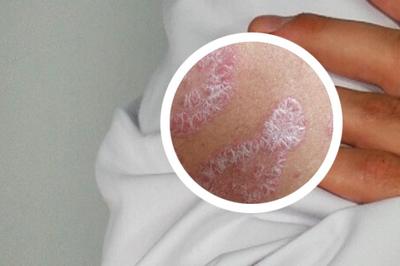 牛皮癣广告模板 专业治疗，重获健康肌肤