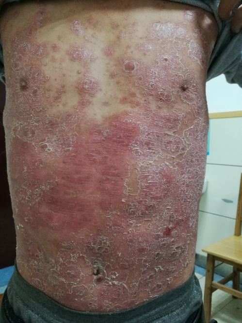 银屑病（牛皮癣）治疗病例分享 从困扰到缓解的历程