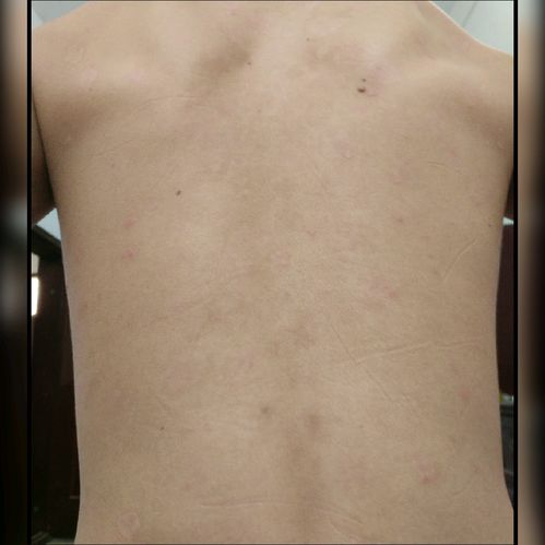 精神因素与牛皮癣（银屑病）的关联及应对策略