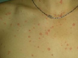 牛皮癣的症状与初期表现