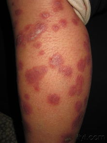 银屑病（牛皮癣） 症状、病因与治疗方法解析