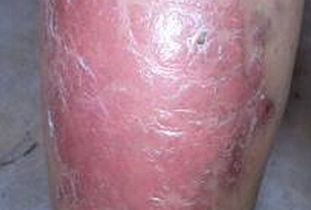 牛皮癣的西医诊断方法