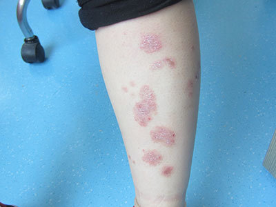 银屑病（牛皮癣）患者的自我管理与生活建议