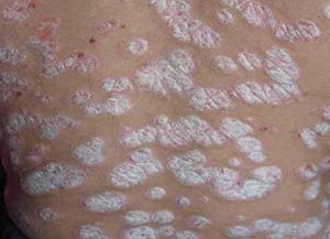 牛皮癣的危害性 不仅仅是皮肤问题