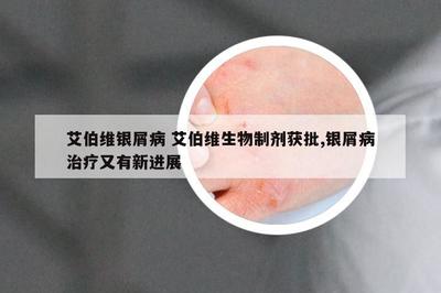 艾伯维生物制剂获批，银屑病治疗迎来新突破