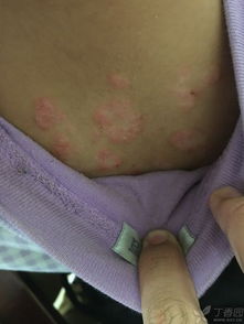 牛皮癣 不只是皮肤上的“癣”，更需科学认知与规范治疗