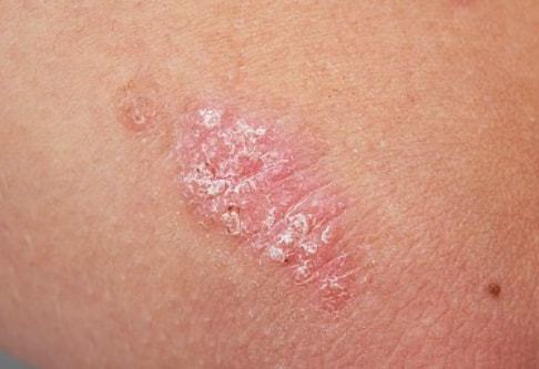 牛皮癣的“消失”与缓解 如何科学判断银屑病进程