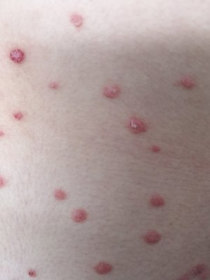 急性点滴型银屑病 探寻“元凶”与科学认知