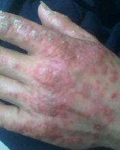 关爱皮肤健康 了解牛皮癣的正确观念与护理方法