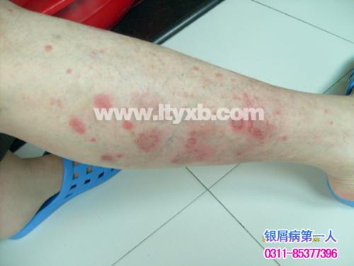 银屑病（牛皮癣）科普 症状识别、误区澄清与科学应对
