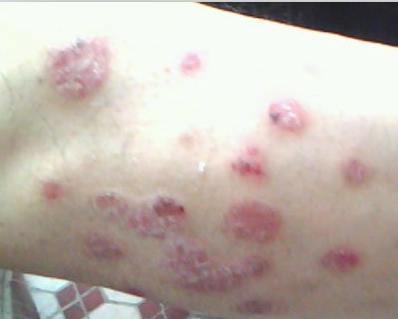 北京银屑病权威诊疗机构推荐与就医指南